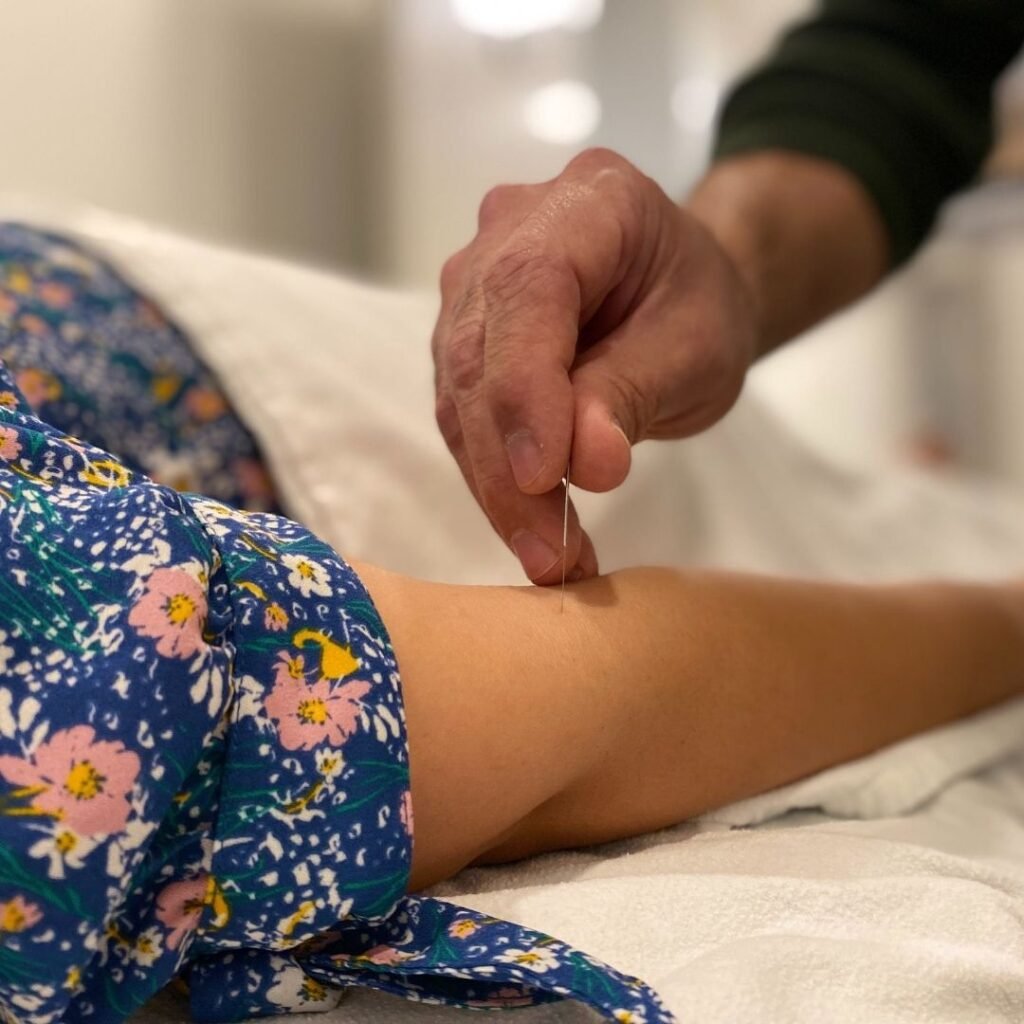 acupuncture(1) Acupuncture